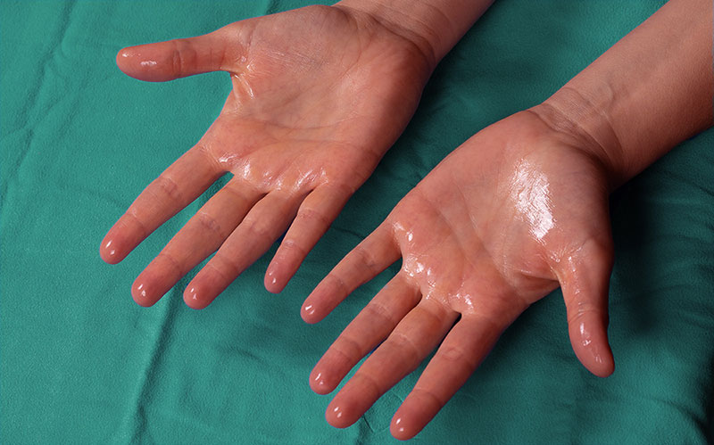 hiperhidrosis-palmar-consejo-y-tratamiento-hidroxa-espa-ol